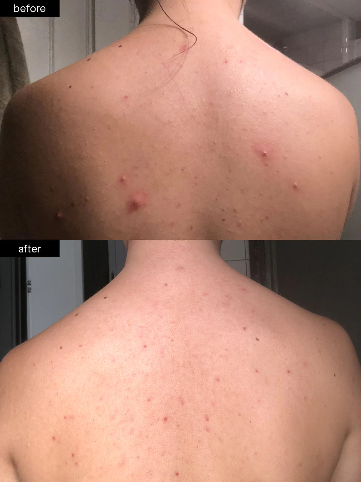 SLMD Body Acne System set