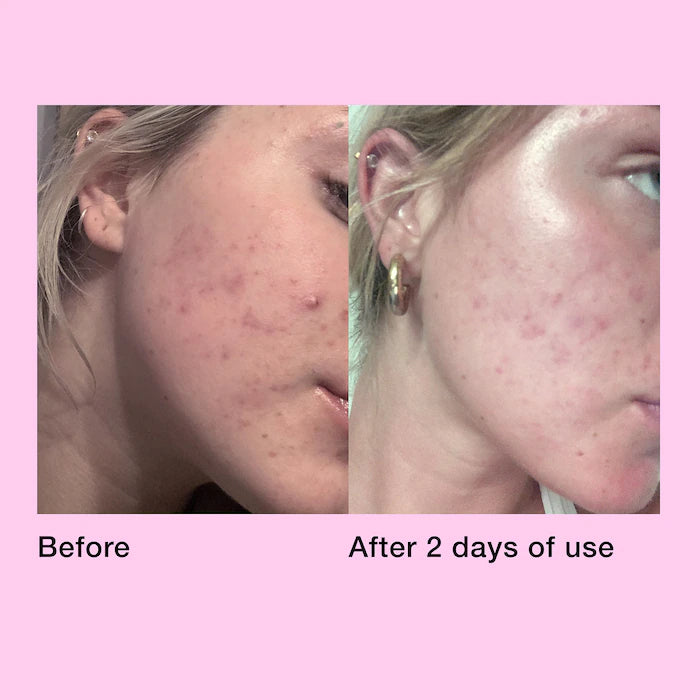 Innbeauty PROJECT Pimple Paste Overnight