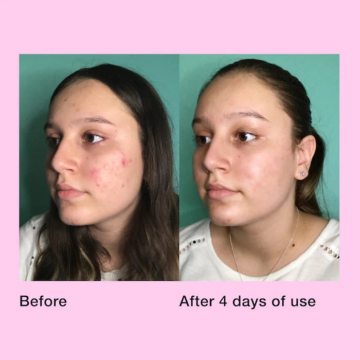 Innbeauty PROJECT Pimple Paste Overnight