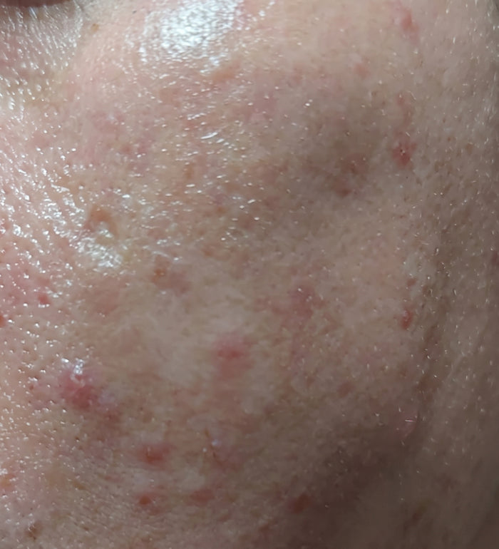 Saved My Skin