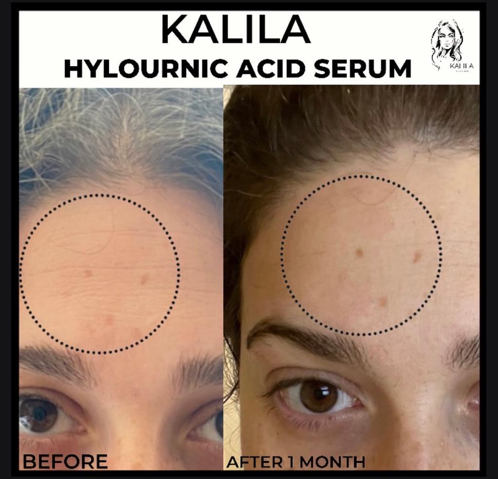 KALILA Hyaluronic Acid Serum, 30ml + 6ml Free